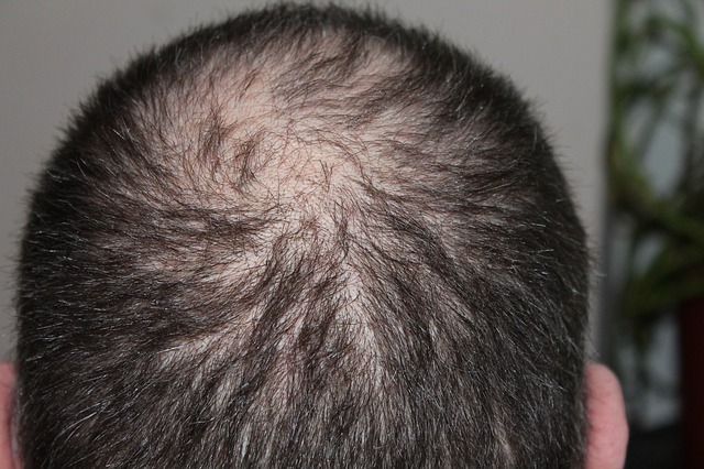 how to regrow lost hair ayurveda